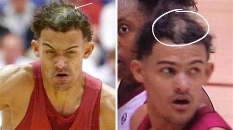 trae young hairline|trae young hair loss.